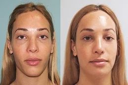 النتائج تصغير الذقن في دبي