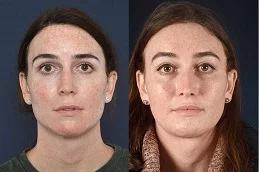 النتائج تصغير الذقن في دبي
