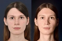النتائج تصغير الذقن في دبي