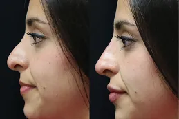 نتائج تجميل الأنف في دبي وأبوظبي