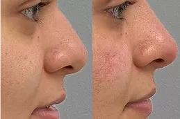 نتائج تجميل الأنف في دبي وأبوظبي.,.,,