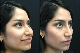 نتائج تجميل الأنف في دبي وأبوظبي.