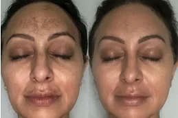 نتائج تقشير كوزميلان
