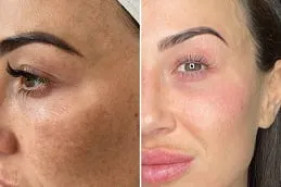 نتائج تقشير كوزميلان