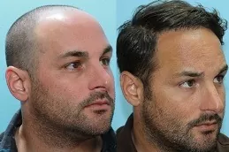 نتائج زراعة الشعر في دبي,.,
