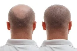 نتائج زراعة الشعر في دبي,.,