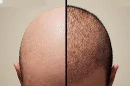 نتائج زراعة الشعر في دبي,.,