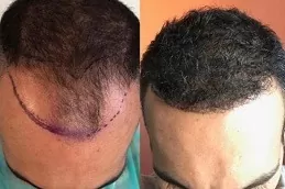 نتائج زراعة الشعر في دبي
