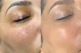 نتائج علاج بي بي جلو في دبي
