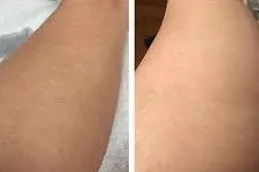 نتائج علاجات الليزر في دب,.