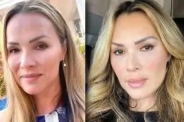 نتائج عملية شد الوجه بتقنية ذيل الحصان في دبي