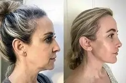 نتائج عملية شد الوجه بتقنية ذيل الحصان في دبي
