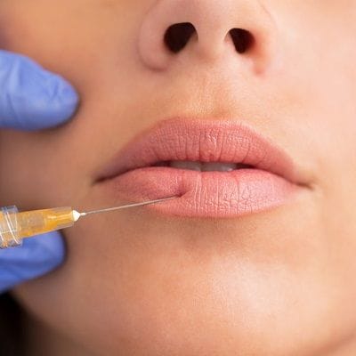 Lip Fillers Injection Cost in Dubai