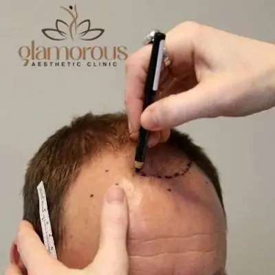 تكلفة زراعة الشعر بتقنية FUE في دبي