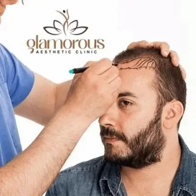 زراعة الشعر في جميرا، دبي