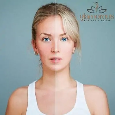 skin laser treatment price in dubai
