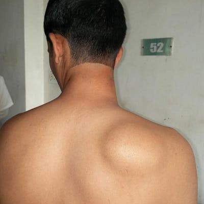 علاج الورم الشحمي بدون جراحة في دبي