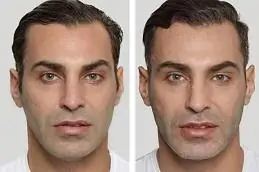,نتائج علاج الوجه بسكولبترا