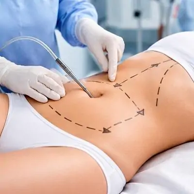 أفضل جراح لشفط الدهون في دبي