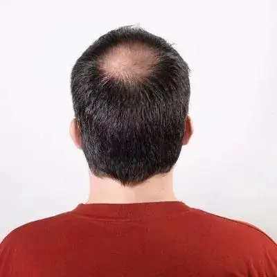 زراعة الشعر بدون حلاقة في دبي