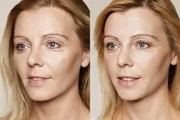 Инъекции Skin Booster до и после.