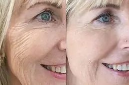Инъекции Skin Booster до и после