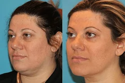 Клиника Sculptra Fillers в Дубае