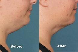 Лечение Kybella до и после,