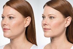 Лечение Kybella в Дубае,