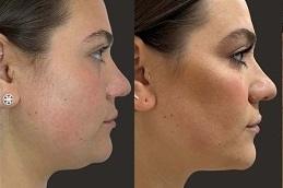 Лечение Kybella до и после,