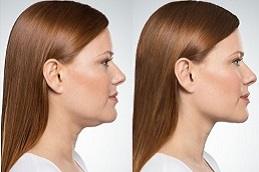 Лечение Kybella до и после,