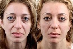Филлеры под глазами в Дубае