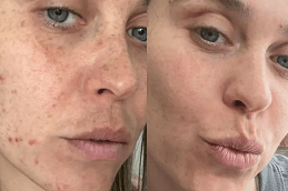 Best Deep Cleansing Facial in Dubai