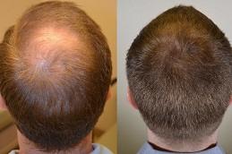 Best Finasteride for Hair Loss in Dubai