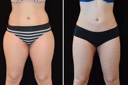 Best Laser Skin Whitening for Inner Thighs in Dubai