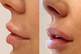 Best Subtle Lip Fillers in Dubai