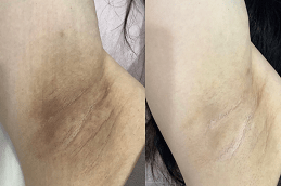 Best Underarm Whitening Treatment UAE
