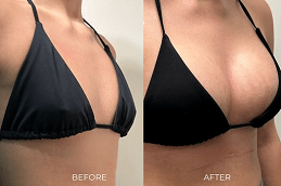 Breast Fillers Injections in Dubai