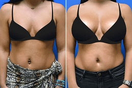 Breast Fillers Injections in UAE
