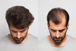 Finasteride for Hair Loss in Dubai uae