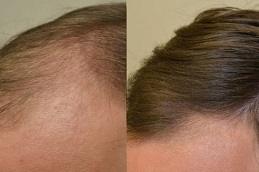 Finasteride for Hair Loss in Dubai