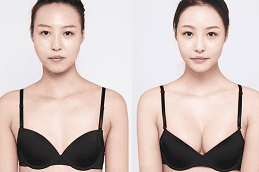 How Much Does Breast Injections Cost in Dubai