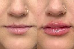 Subtle Lip Fillers in Dubai uae