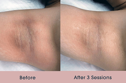 Underarm Whitening Treatment in Dubai