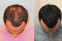 ACell PRP Therapy Hair Loss in Dubai