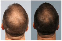 ACell PRP Therapy Hair Loss in UAE