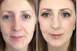 Baby Botox in Dubai & Abu Dhabi