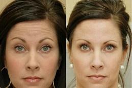 Baby Botox in Dubai uae