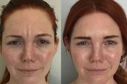 Best Baby Botox in Dubai
