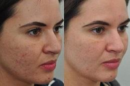 Best Fractional Co2 Laser Treatment Cost Dubai & Abu Dhabi